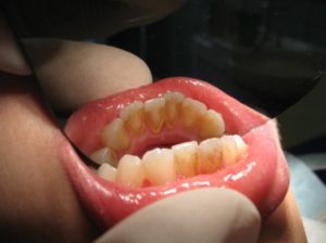 Fogkőeltávolítás előtt Fogkőeltávolítás előtt