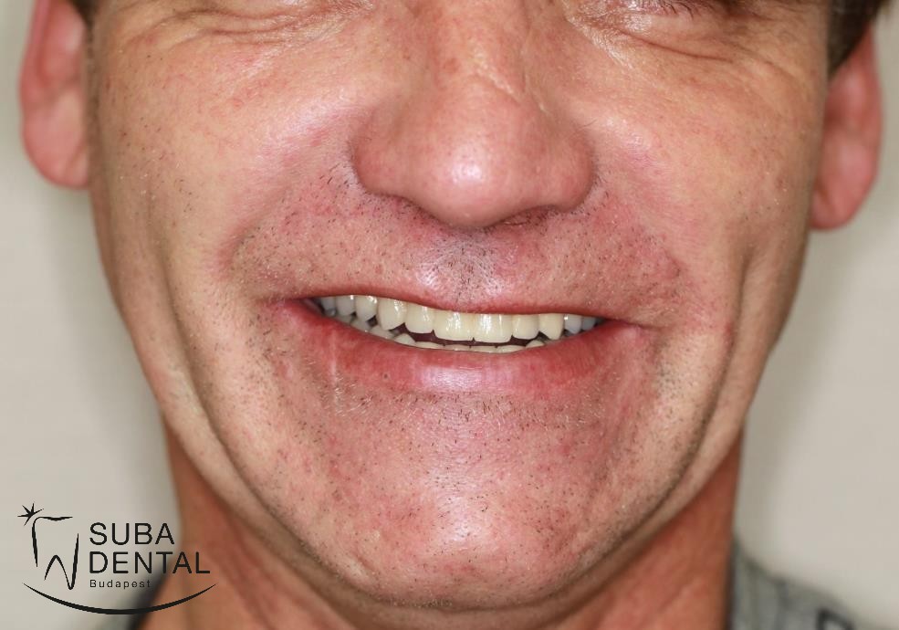 Ragasztható fémkerámia koronák saját fogakra és implantátumokra