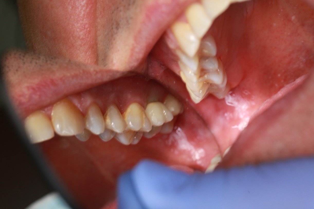 Csavarozható implantátum korona (esettanulmány)(14)