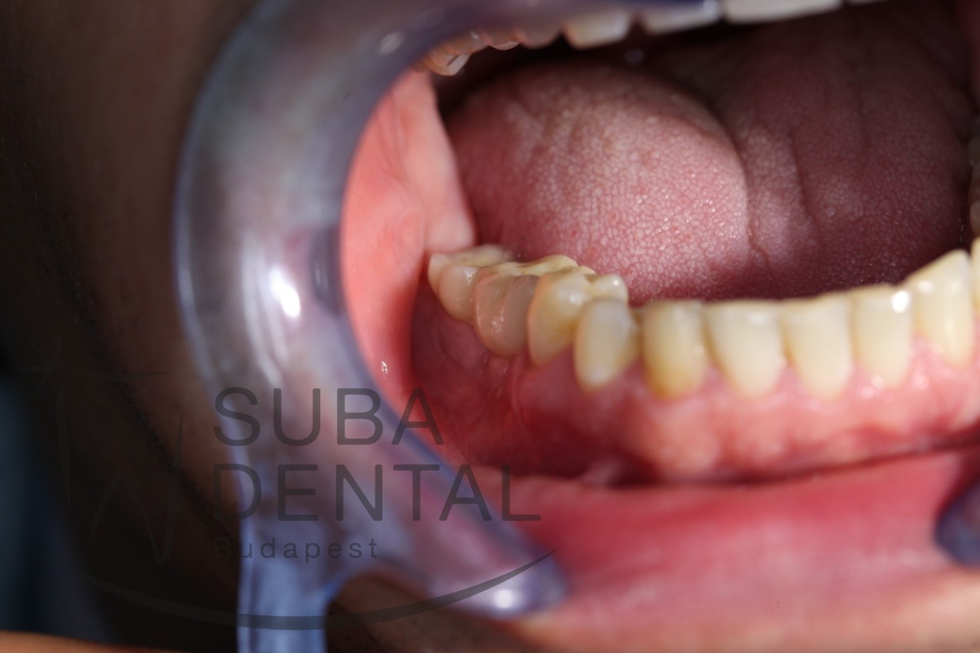 Csavarozható implantátumhíd Straumann implantátumra (esettanulmány) (15)