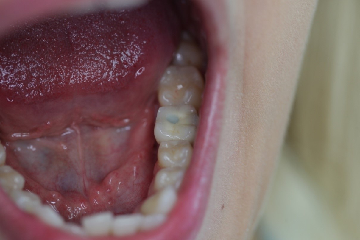 Csavarozható implantátum korona (esettanulmány)(13)