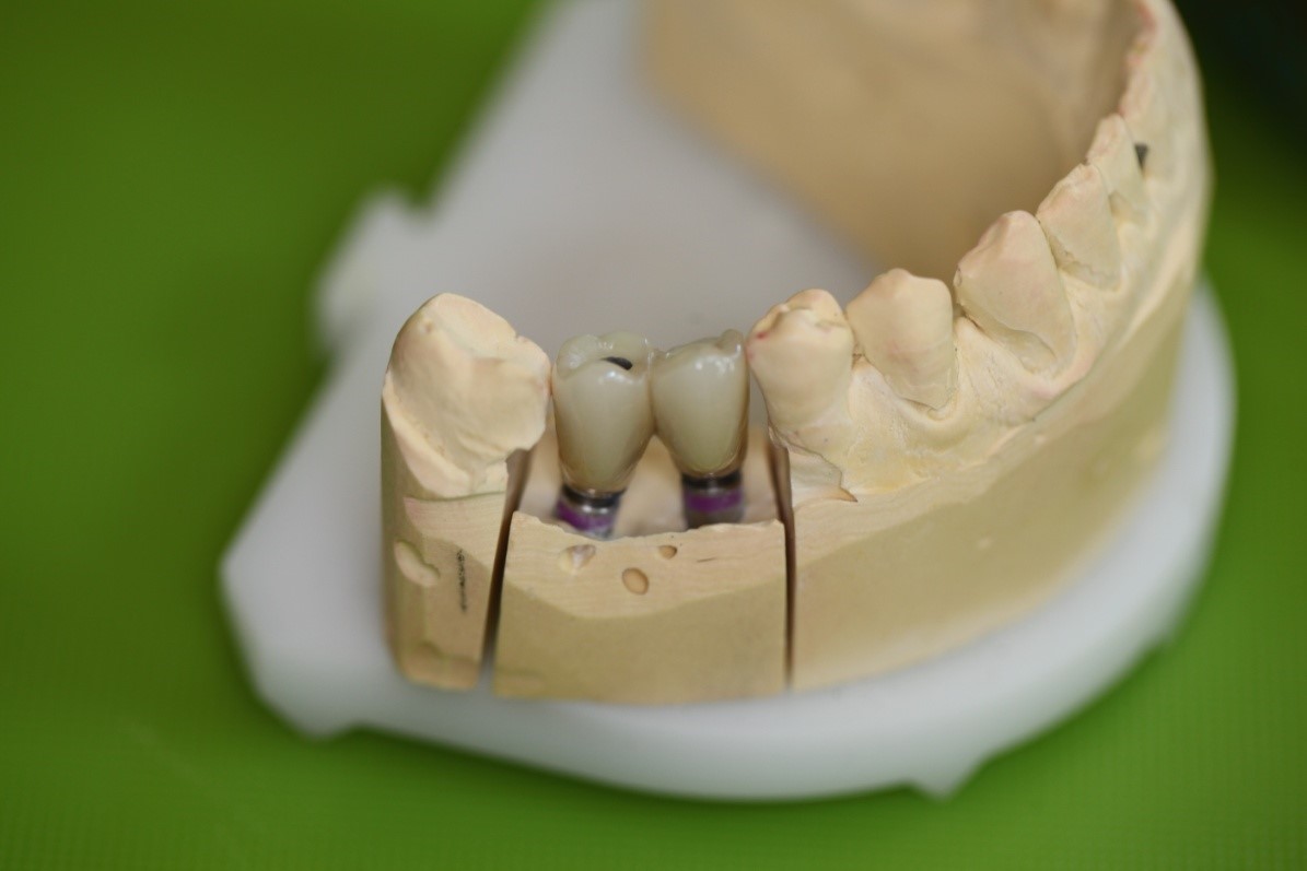 Csavarozható implantátum híd (esettanulmány) (18)