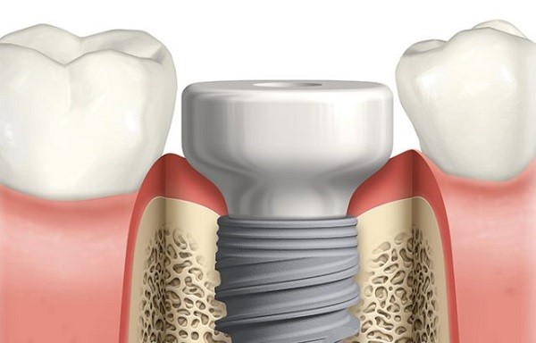 What are healing abutments (gingiva formers) and cover screws in implants? (63)