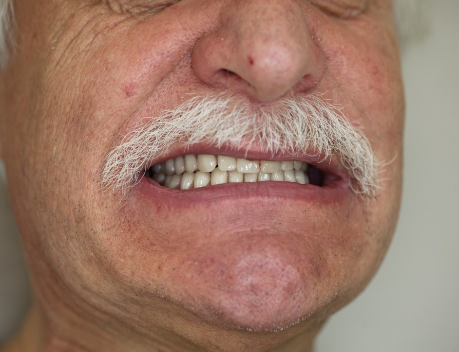 Extraction des dents du patient souffrant de la maladie parodontale et préparation d'une prothèse immédiate (étude de cas)