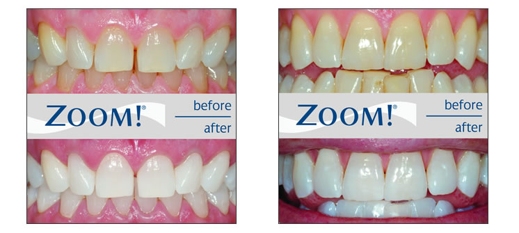 Professional Zoom teeth whitening