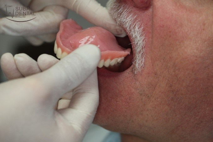 Fogbeültetés (implantálás), ideiglenes fogsor alábélelése (esettanulmány) (20)