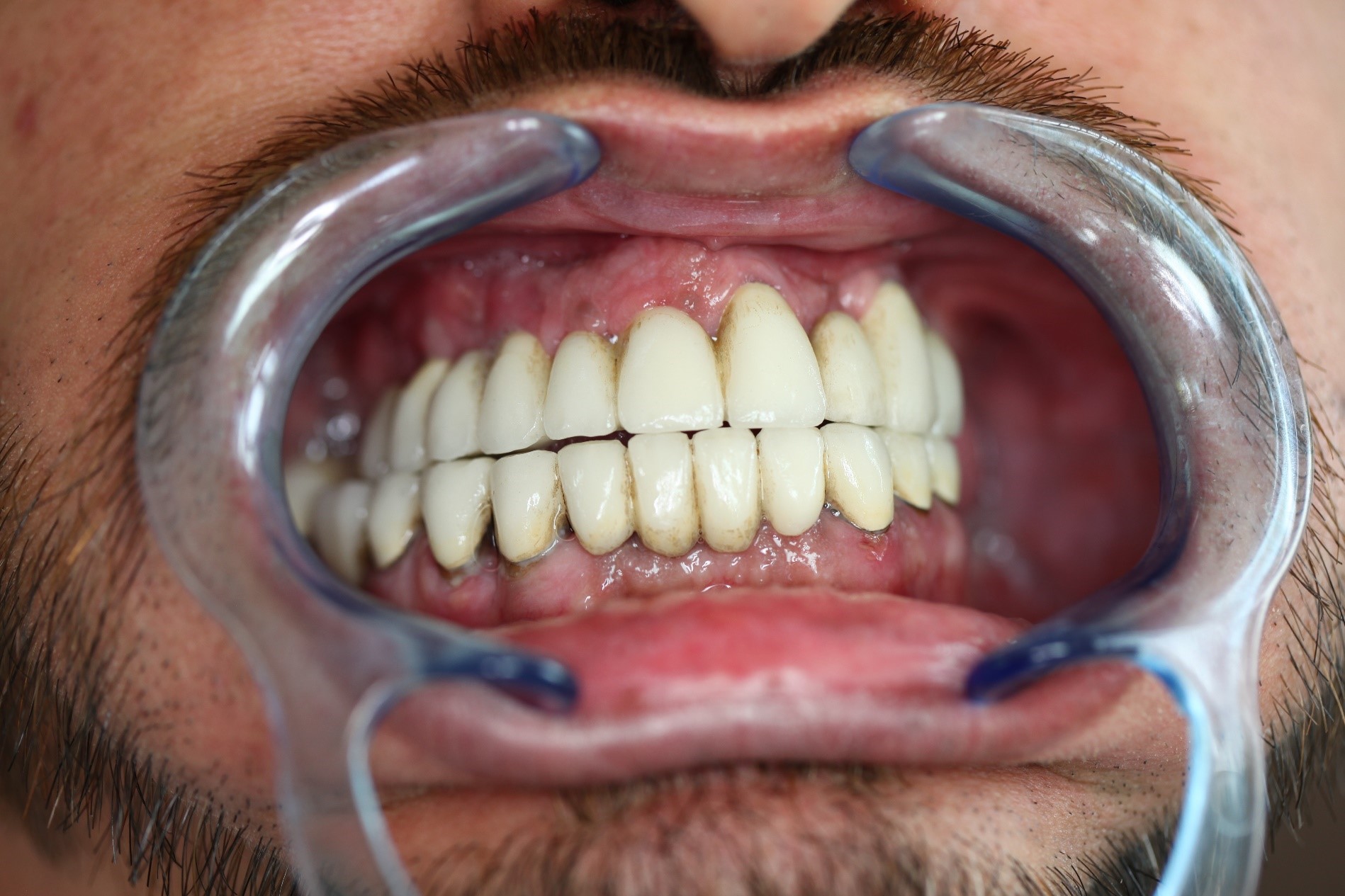 Implant rejection and tooth loss arising from the omission of regular check-ups, follow-up X-rays, regular tartar removal, and heavy smoking (Case presentation) (41)