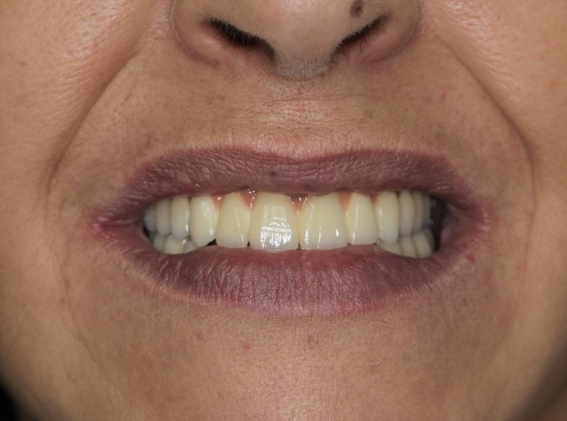 Bridge complet sur implant scellé