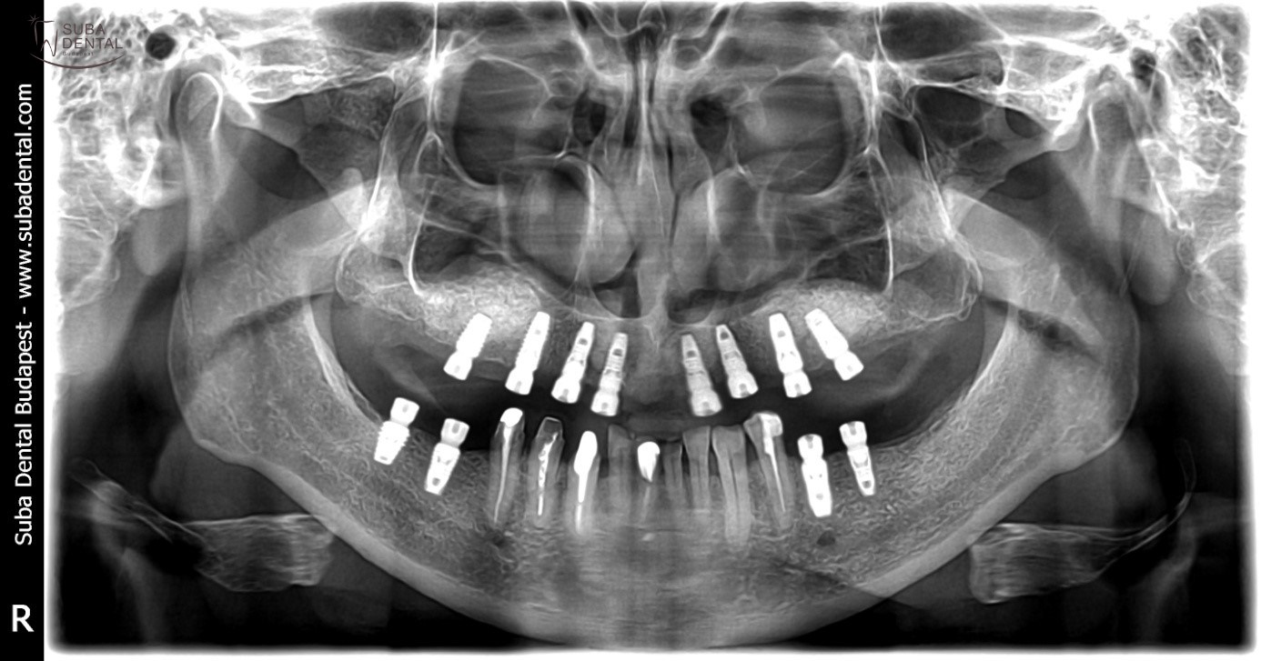 Hiányzó fogak pótlása implantátumokkal II. rész Sinus lift, arcüregemelés (22)