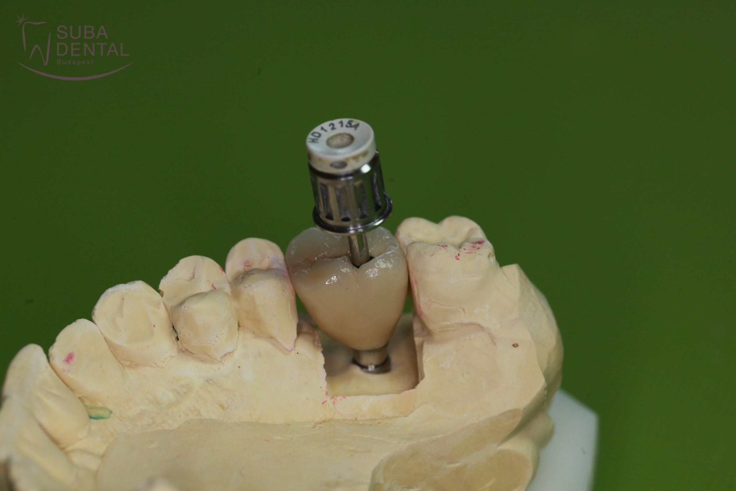 Tooth extraction, bone graft (sinus lift), implant surgery, screw-retained implant fabricated with CAD CAM technology, metal-ceramic crown (Case presentation) (39)
