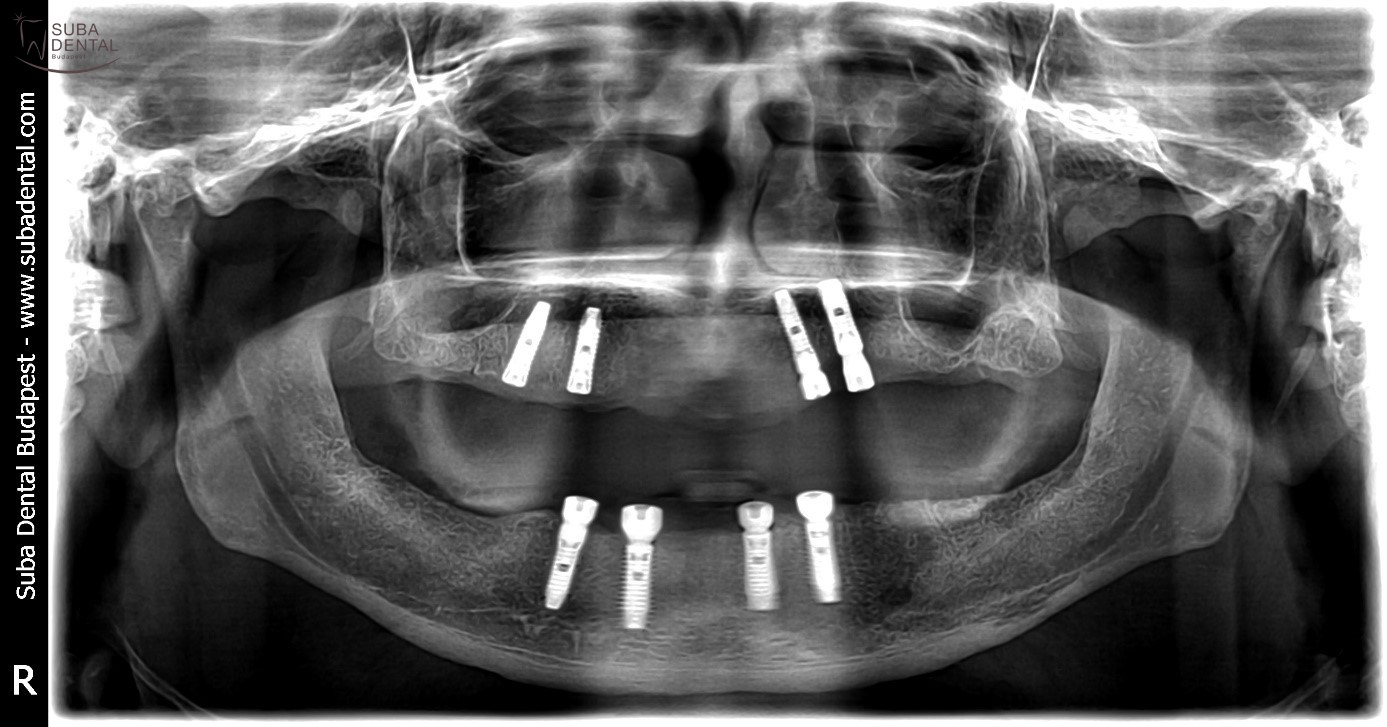 Tooth extractions, fabrication of bar denture mounted on 4 implants (All-on-4) Treatment phase II – Implant surgery (Case presentation) (60 )