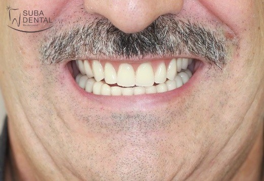 Implantátumokon elhorgonyzott stéges fogsorok készítése  III. kezelési fázis (Esetbemutató) (65)