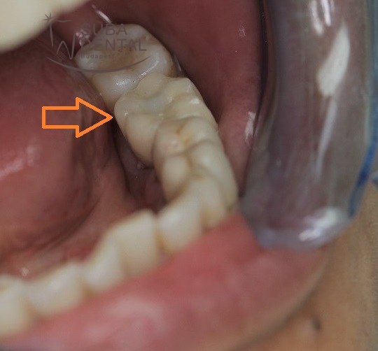 Straumann® implantátum beültetése és fémkerámia csavarozható implant korona készítése (Esetbemutató) (52)