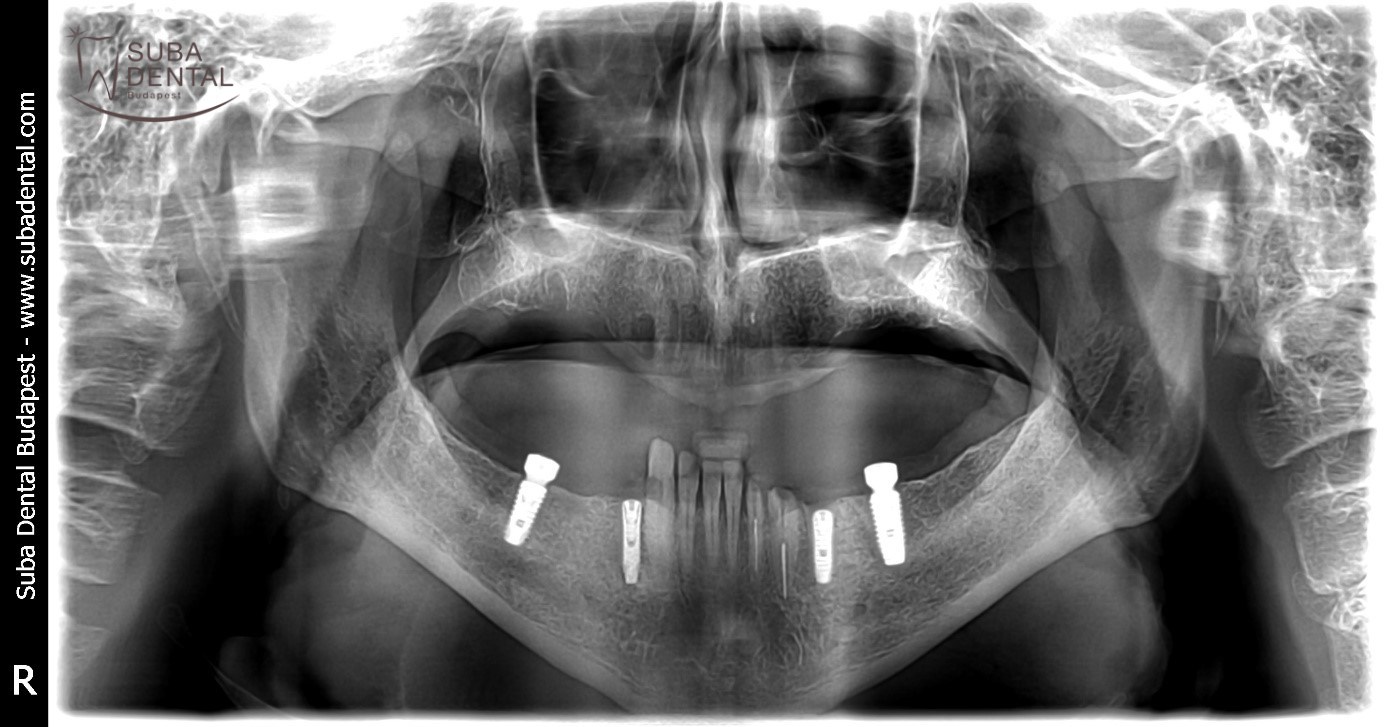 Treatment phase II – dental implant surgery (Case presentation) (68)