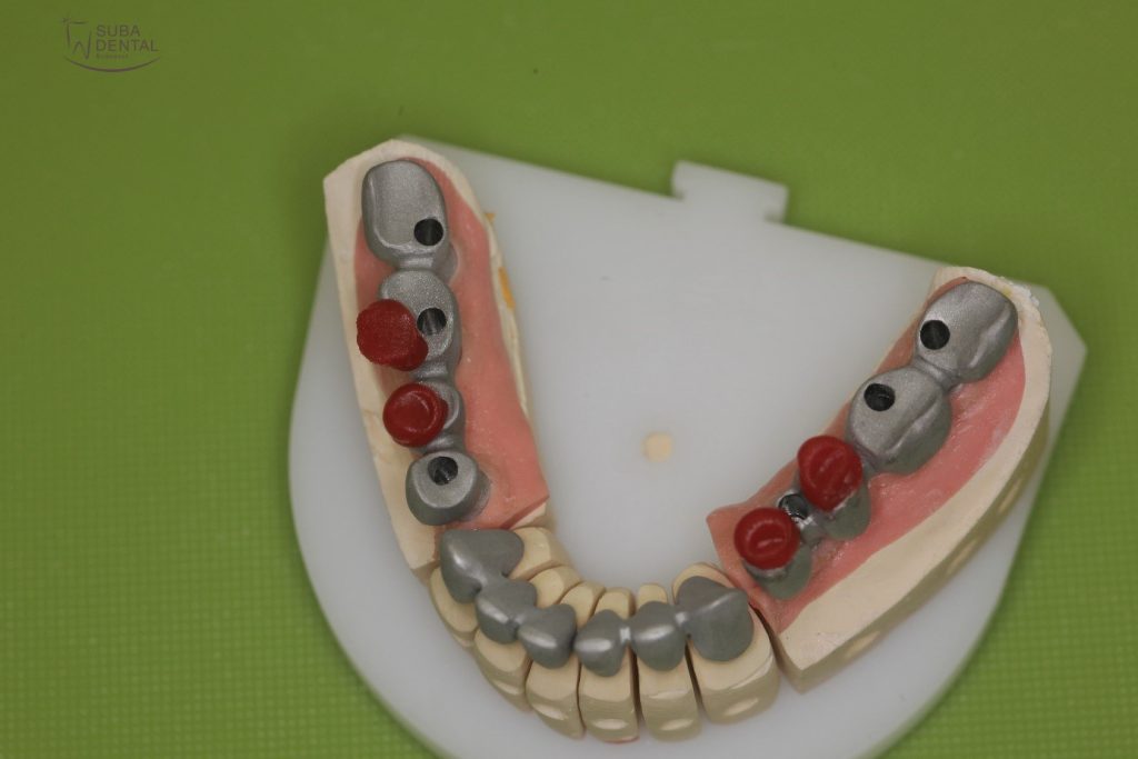 Az alsó frontfogakra készülő fémkerámia hidak és az implantátumokra készülő csavarozható fémkerámia hidak fémváza a mestermintán