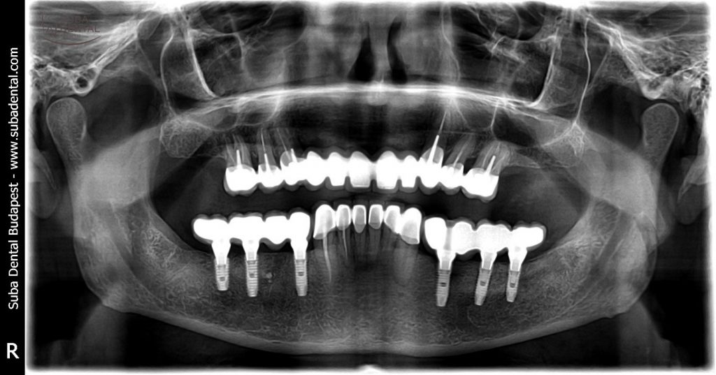 Az elkészült fémkerámia hidak és csavarozható implantátum hidak átadása után készült kontroll panorámaröntgen-felvétel