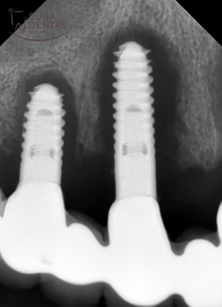 Implantátumok körüli idült gyulladás, súlyos periimplantitis intraorális röntgenfelvételen. 6 év alatt egyszer sem jött el a beteg fogkőtisztításra, teljesen elhanyagolta a szájhigiéniát, mert már „szépek a fogai” és a dohányzásról sem szokott le. A csont az implantátum körül teljesen felszívódott, a „szép” híd gennyben úszó implantátumokon áll. Sajnos mindegyik implantátumot el kellett távolítani (explantáció)
