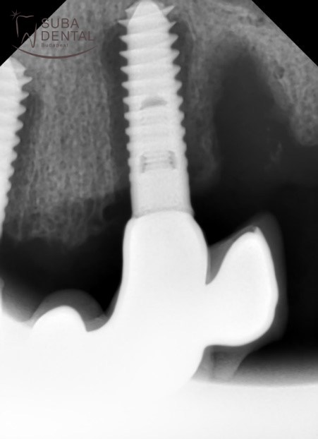 Implantátumok körüli idült gyulladás, súlyos periimplantitis intraorális röntgenfelvételen. 6 év alatt egyszer sem jött el a beteg fogkőtisztításra, teljesen elhanyagolta a szájhigiéniát, mert már „szépek a fogai” és a dohányzásról sem szokott le. A csont az implantátum körül teljesen felszívódott, a „szép” híd gennyben úszó implantátumokon áll. Sajnos mindegyik implantátumot el kellett távolítani (explantáció)