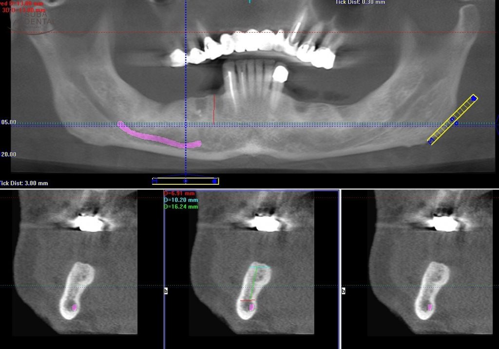 CBCT felvétel, melyen az állcsontok csontkínálatát 3 dimenzióban vizsgálhatjuk, megtervezzük az implantátumok pontos helyét, méretét és kijelölhetjük a nervus alveolaris inferior lefutását.