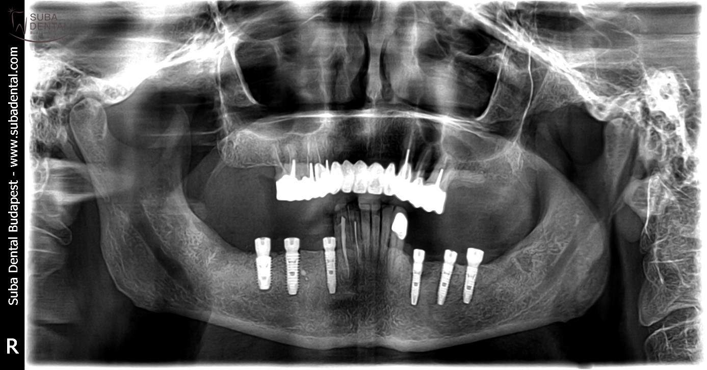 Gócos fogak eltávolítása, implantátumok beültetése, fémkerámia koronák készítése, csavarozható fémkerámia implantátum koronák (Esetbemutató) (70)