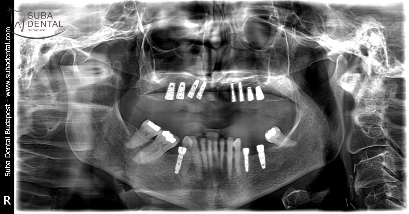 Remplacement des dents manquantes par des implants, couronnes métallo-céramiques sur les implants et sur les dents naturelles Première phase de traitement - implants dentaires (Présentation de cas) (91)