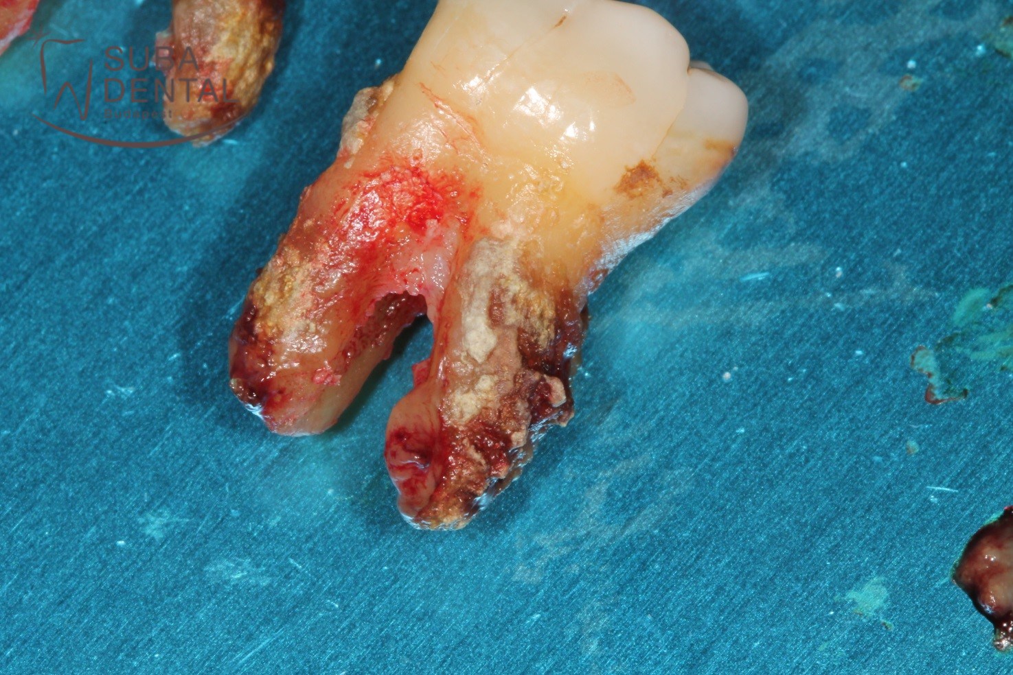 Periodontal disease (87)