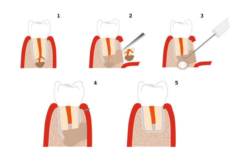 Root-end surgery (apical resection, apicoectomy) (90)