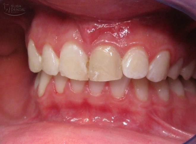 Internal bleaching or walking bleach (86)