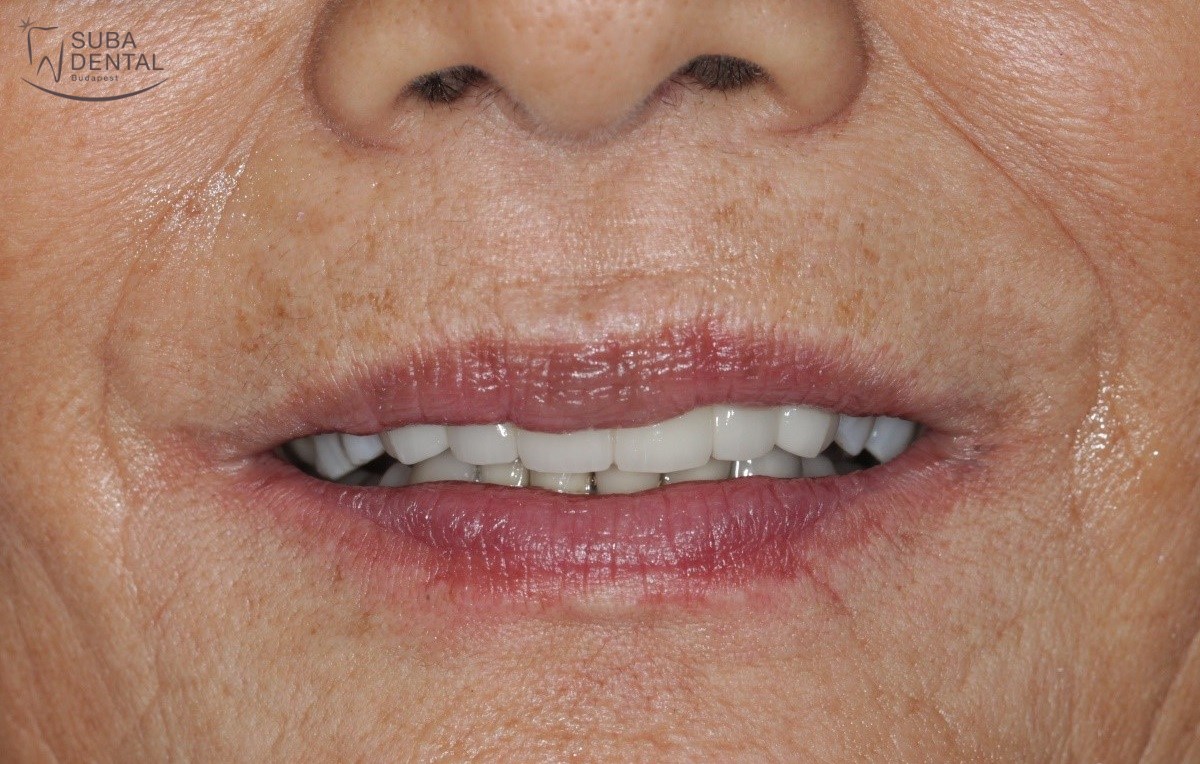 Case report Aesthetic makeover, preparation of an upper front zirconia bridge (93)