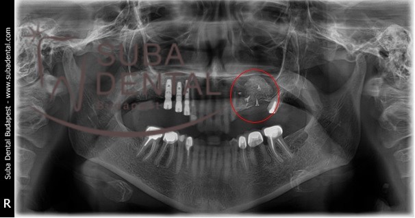 Horizontal and vertical bone augmentation (using Urbán’s method) (126)