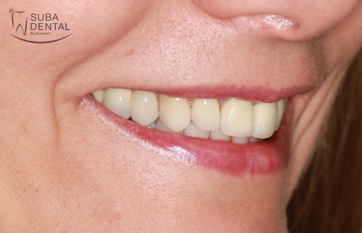 Case report no. 94 The replacement of old metal ceramic crowns with metal-free zirconia crowns (94)