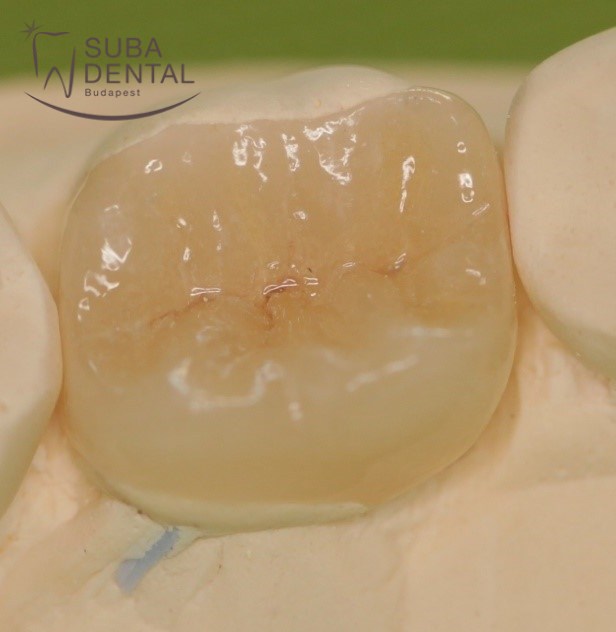 Dental inlays and onlays (101)