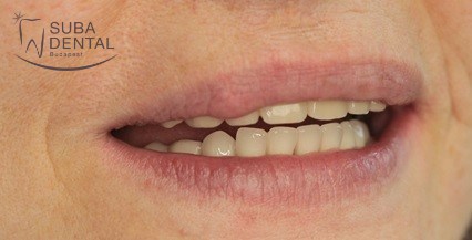 4 implantátumon elhorgonyzott Lokátoros fogsor készítése (162)